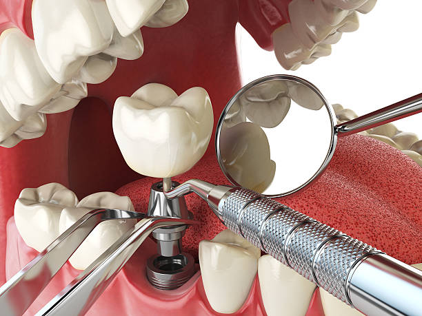 Best Broken or Chipped Tooth Repair in Lagrange, IN